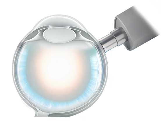 MeticTouch non-invasive delivery
